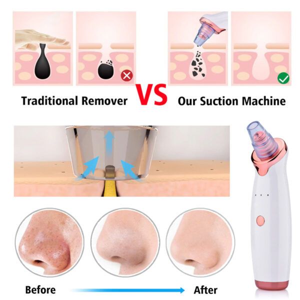 Blackhead-Remover-P4.jpg